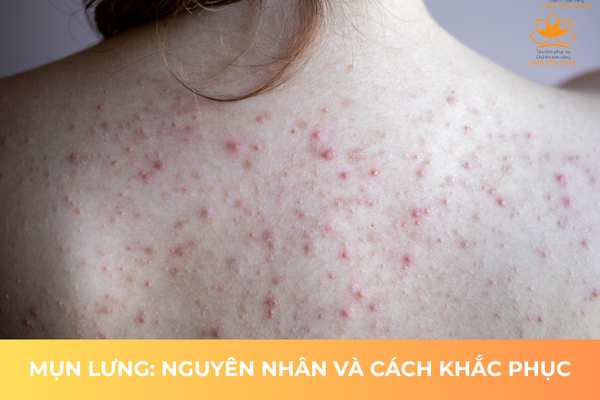 Mụn Lưng: Nguyên Nhân Và Cách Khắc Phục 